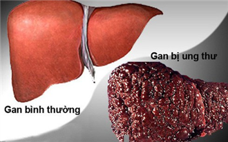 Vượt qua ung thư phổi, ung thư gan trở thành đại dịch