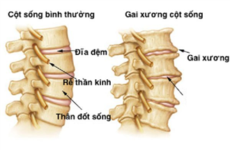 Bước đột phá mới trong Y học giúp điều trị dứt điểm các bệnh về xương khớp