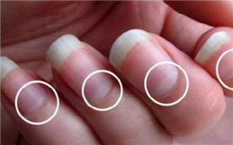 Những dấu hiệu từ móng tay cảnh báo ung thư hoặc gan 