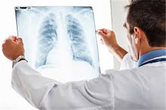 Tràn màng khí phổi sau 5 năm hút thuốc lá
