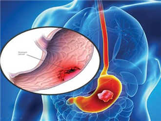 Để phát hiện sớm các loại bệnh ung thư, bắt buộc phải chú ý 4 điều sau