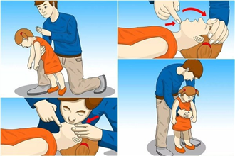 Cách sơ cứu người hóc dị vật
